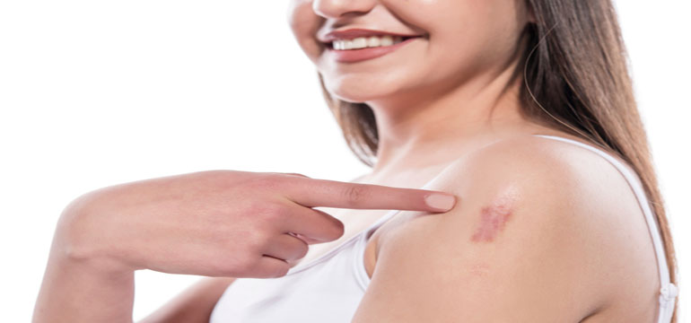 Ada Bekas Luka di Kulit Anda, Keloid atau Bukan?