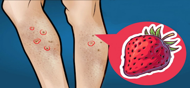 4 Langkah Menghilangkan Strawberry Legs Secara Alami