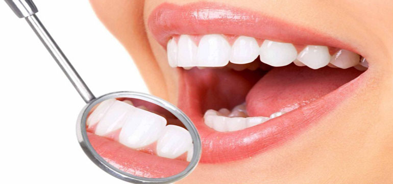 Pilih Veneer Atau Whitening Untuk Memutihkan Gigi